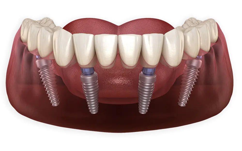 1all-on-4-dental-implants.jpg