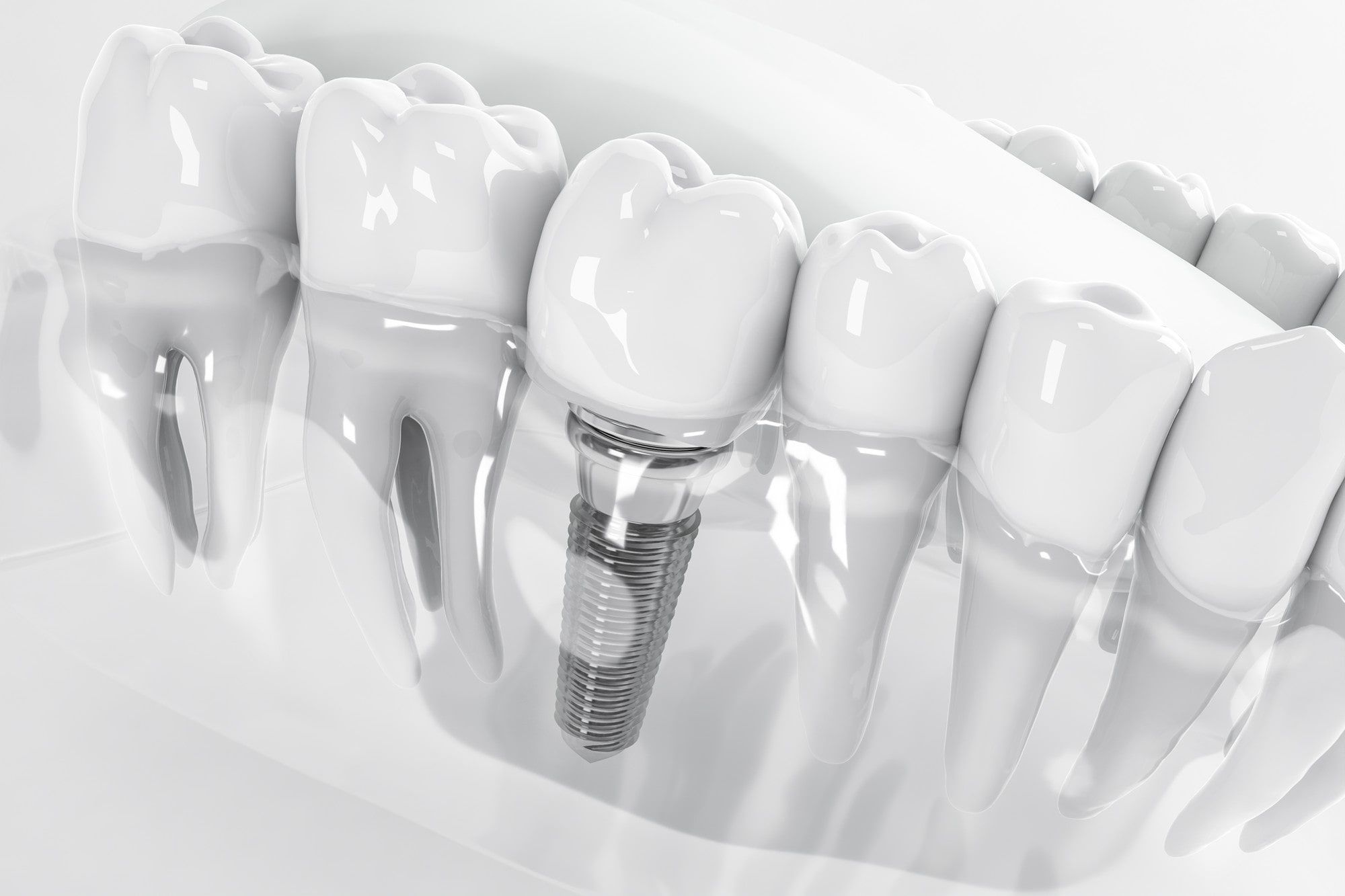 20230126165030_[fpdl.ir]_view-from-false-tooth-implant-fixed-jawbone-3d-3d-illustration_78895-2204 (3)-min.jpg
